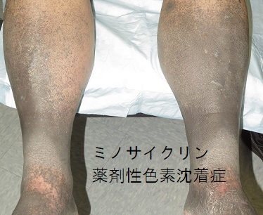 ミノサイクリン薬剤性色素沈着症 ミノサイクリン薬剤性色素沈着症