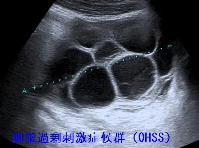 卵巣過剰刺激症候群(OHSS)超音波(エコー)画像 卵巣過剰刺激症候群(OHSS)超音波(エコー)画像
