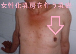 女性化乳房を伴う乳癌 女性化乳房を伴う乳癌