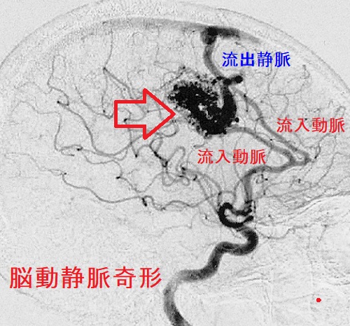 脳動静脈奇形(AVM) 脳動静脈奇形(AVM)