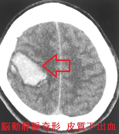 脳動静脈奇形(AVM) 皮質下出血 脳動静脈奇形(AVM) 皮質下出血