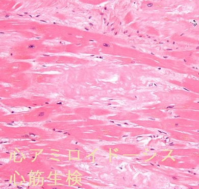 甲状腺アミロイドーシス・結節性甲状腺アミロイドーシス[橋本病