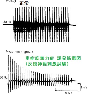 重症筋無力症 誘発筋電図(反復神経刺激試験 重症筋無力症 誘発筋電図(反復神経刺激試験
