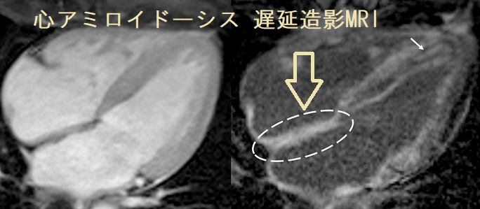 心アミロイドーシス 遅延造影MRI 心アミロイドーシス 遅延造影MRI