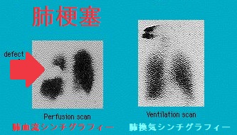 肺血流シンチグラフィー・肺換気シンチグラフィー 肺血流シンチグラフィー・肺換気シンチグラフィー