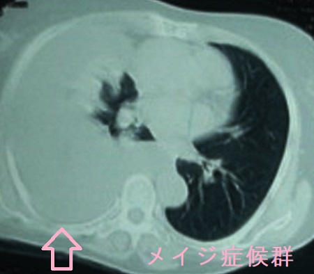 メイジ症候群 肺CT画像 メイジ症候群 肺CT画像