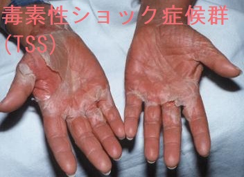 毒素性ショック症候群(TSS) 毒素性ショック症候群(TSS)