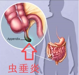 虫垂炎 虫垂炎