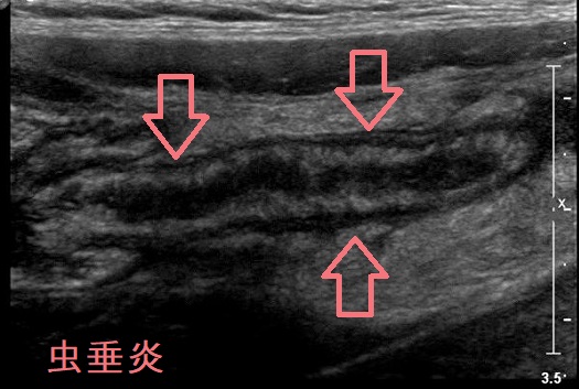 虫垂炎 超音波(エコー)画像 虫垂炎 超音波(エコー)画像