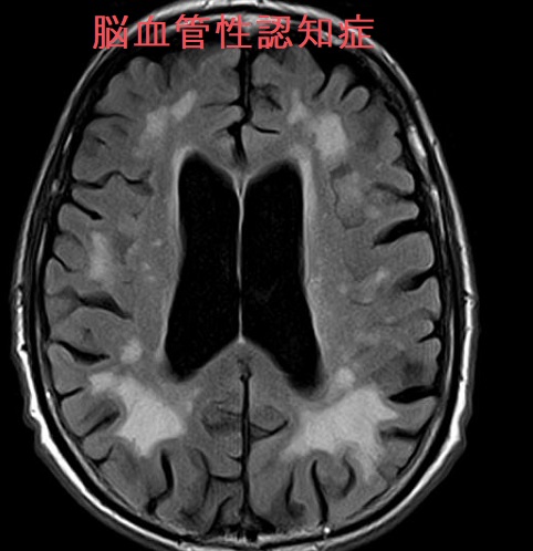 脳血管性認知症 脳血管性認知症