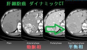 肝細胞癌 ダイナミックCT画像 肝細胞癌 ダイナミックCT画像