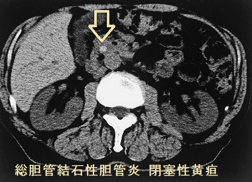 総胆管結石性胆管炎 閉塞性黄疸 CT画像 総胆管結石性胆管炎 閉塞性黄疸 CT画像