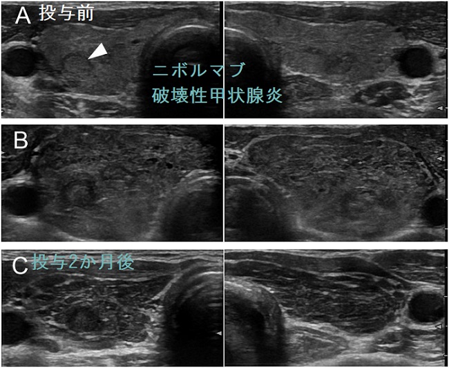 ニボルマブ(オプジーボ®)破壊性甲状腺炎の経過 ニボルマブ(オプジーボ®)破壊性甲状腺炎の経過