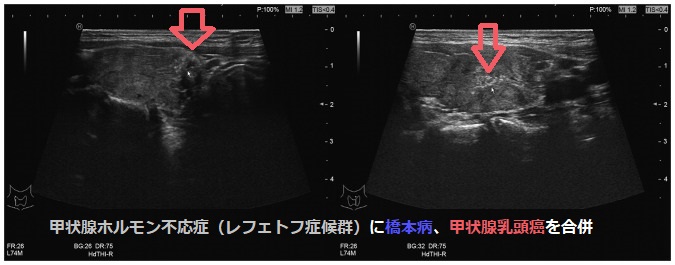 甲状腺ホルモン不応症(レフェトフ症候群)に橋本病、甲状腺乳頭癌を合併 甲状腺ホルモン不応症(レフェトフ症候群)に橋本病、甲状腺乳頭癌を合併