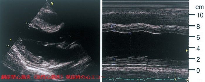 劇症型心筋炎 発症時の心エコー 劇症型心筋炎 発症時の心エコー