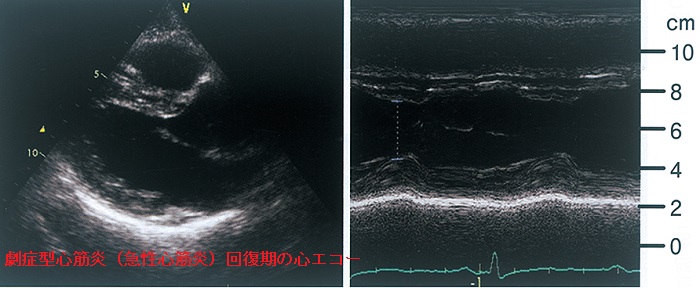 劇症型心筋炎(急性心筋炎)回復期の心エコー 劇症型心筋炎(急性心筋炎)回復期の心エコー