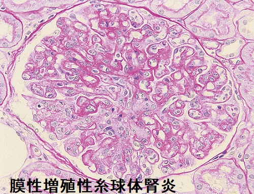 膜性増殖性糸球体腎炎(MPGN) PAS染色 膜性増殖性糸球体腎炎(MPGN) PAS染色