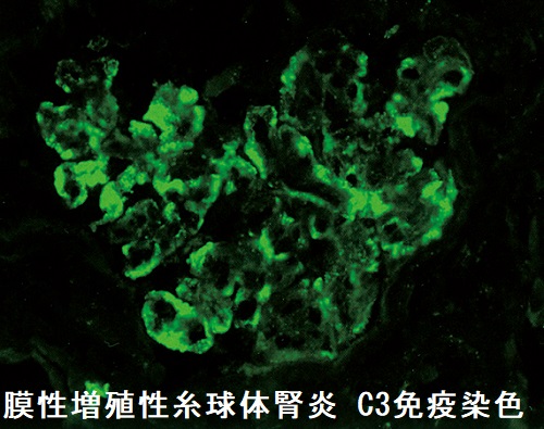 膜性増殖性糸球体腎炎(MPGN) C3免疫染色 膜性増殖性糸球体腎炎(MPGN) C3免疫染色