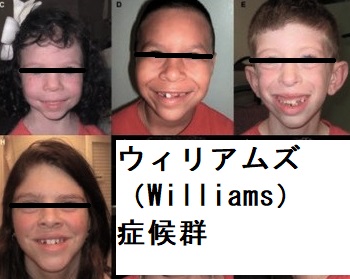 ウィリアムズ(Williams)症候群と甲状腺 ウィリアムズ(Williams)症候群と甲状腺