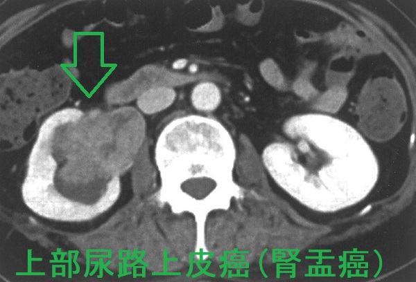 上部尿路上皮癌(腎盂癌) 上部尿路上皮癌(腎盂癌)