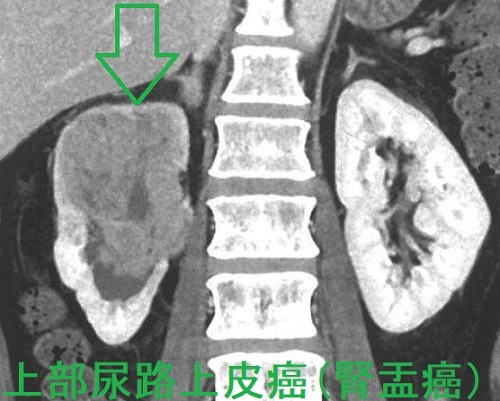 上部尿路上皮癌(腎盂癌) 上部尿路上皮癌(腎盂癌)