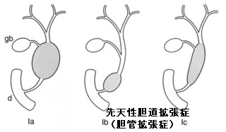 先天性胆道拡張症(胆管拡張症) 先天性胆道拡張症(胆管拡張症)