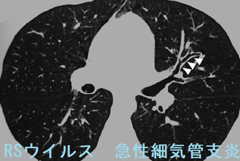 RSウイルス 急性細気管支炎 RSウイルス 急性細気管支炎