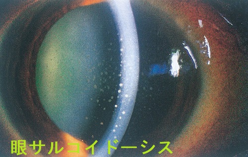 眼サルコイドーシス 眼サルコイドーシス