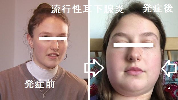 流行性耳下腺炎 流行性耳下腺炎