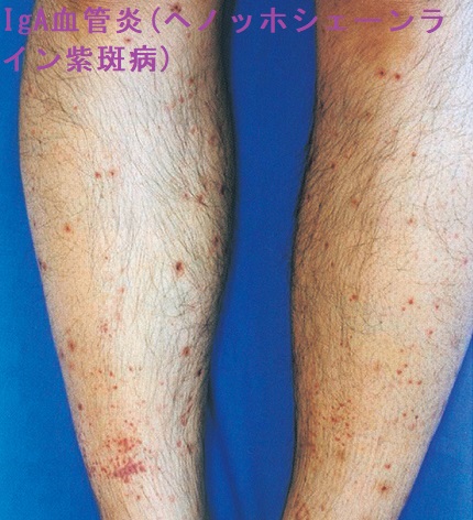 IgA血管炎(アナフィラクトイド紫斑、ヘノッホ・シェーンライン紫斑病) IgA血管炎(アナフィラクトイド紫斑、ヘノッホ・シェーンライン紫斑病)