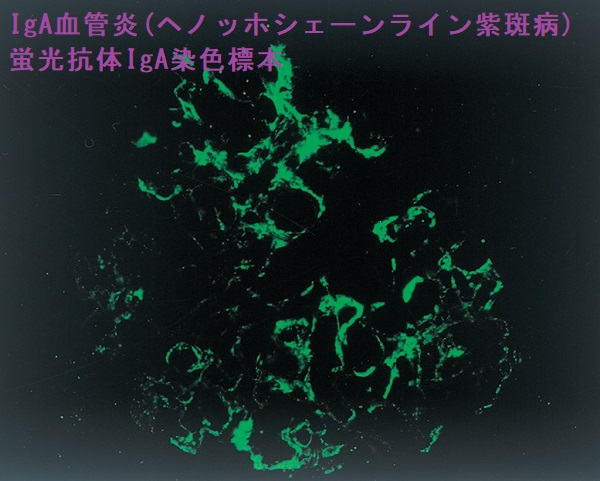 IgA血管炎(ヘノッホシェーンライン紫斑病) 蛍光抗体IgA染色標本 IgA血管炎(ヘノッホシェーンライン紫斑病) 蛍光抗体IgA染色標本