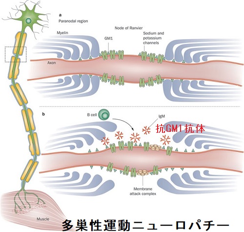 多巣性運動ニューロパチー 多巣性運動ニューロパチー