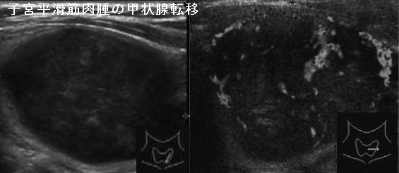 子宮平滑筋肉腫の甲状腺転移 超音波(エコー)画像 子宮平滑筋肉腫の甲状腺転移 超音波(エコー)画像