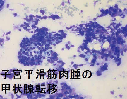 子宮平滑筋肉腫の甲状腺転移 細胞診 子宮平滑筋肉腫の甲状腺転移 細胞診