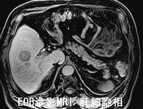 EOB造影MRI 肝細胞相 EOB造影MRI 肝細胞相