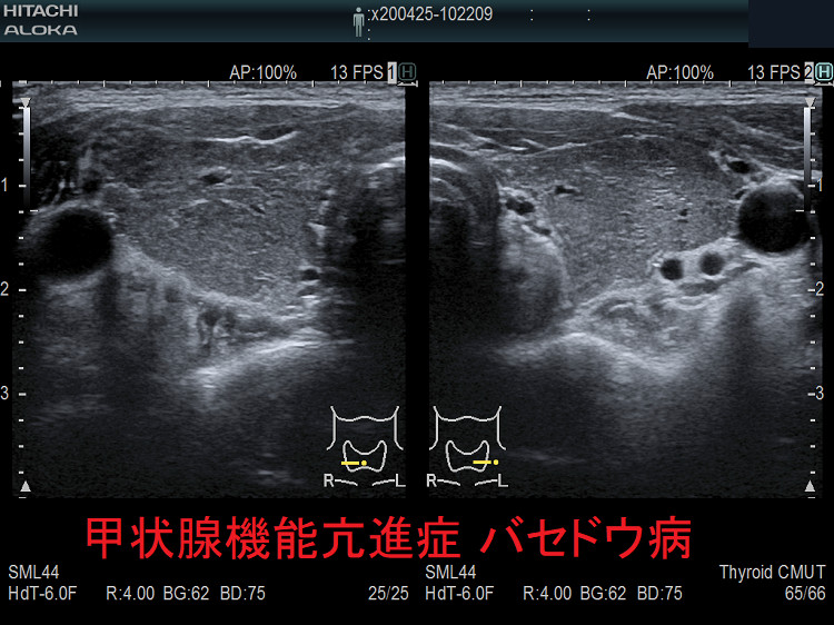 甲状腺機能亢進症 バセドウ病 超音波(エコー)画像 甲状腺機能亢進症 バセドウ病 超音波(エコー)画像