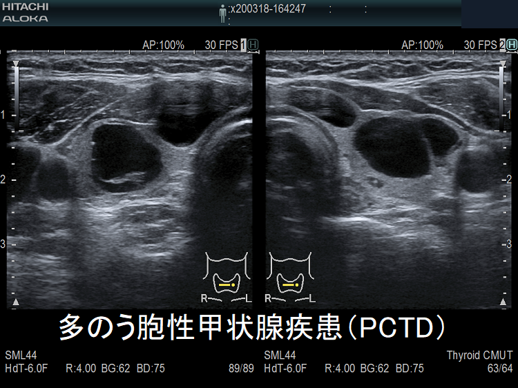 多のう胞性甲状腺疾患(PCTD) 超音波(エコー)画像 多のう胞性甲状腺疾患(PCTD) 超音波(エコー)画像