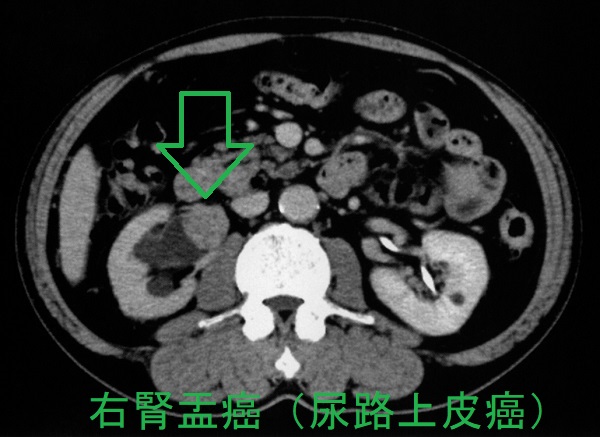 右腎盂癌(尿路上皮癌)1 右腎盂癌(尿路上皮癌)1