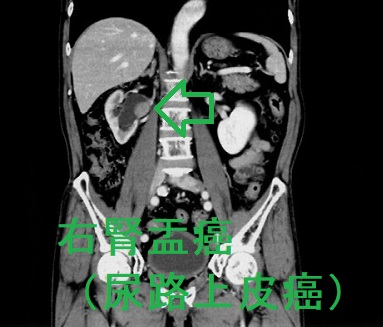 右腎盂癌(尿路上皮癌)2 右腎盂癌(尿路上皮癌)2