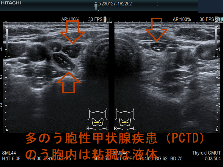 多のう胞性甲状腺疾患(PCTD) 超音波(エコー)画像 のう胞内は粘稠な液体(水平断) 多のう胞性甲状腺疾患(PCTD) 超音波(エコー)画像 のう胞内は粘稠な液体(水平断)