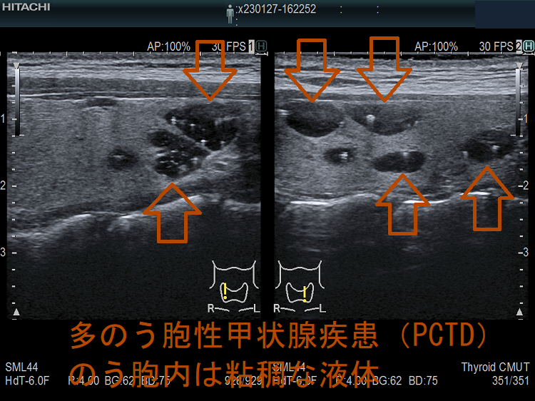 多のう胞性甲状腺疾患(PCTD) 超音波(エコー)画像 のう胞内は粘稠な液体(垂直断) 多のう胞性甲状腺疾患(PCTD) 超音波(エコー)画像 のう胞内は粘稠な液体(垂直断)