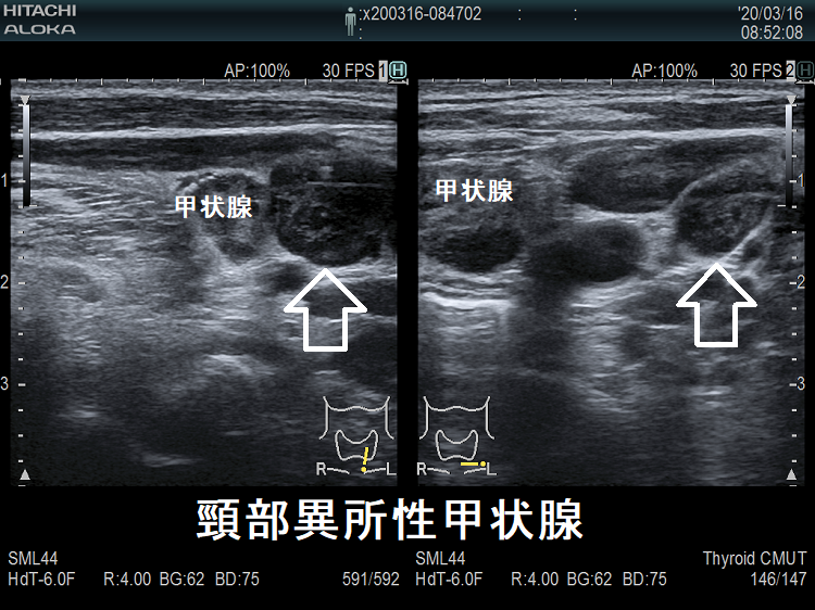 異所性甲状腺 超音波(エコー)画像 異所性甲状腺 超音波(エコー)画像