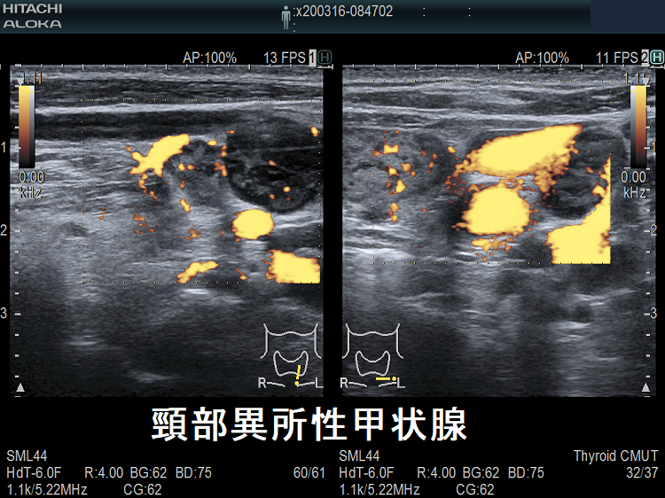 異所性甲状腺 超音波(エコー)画像 ドプラー 異所性甲状腺 超音波(エコー)画像 ドプラー