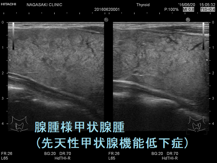 腺腫様甲状腺腫(先天性甲状腺機能低下症) 超音波(エコー)画像(垂直断) 腺腫様甲状腺腫(先天性甲状腺機能低下症) 超音波(エコー)画像(垂直断)