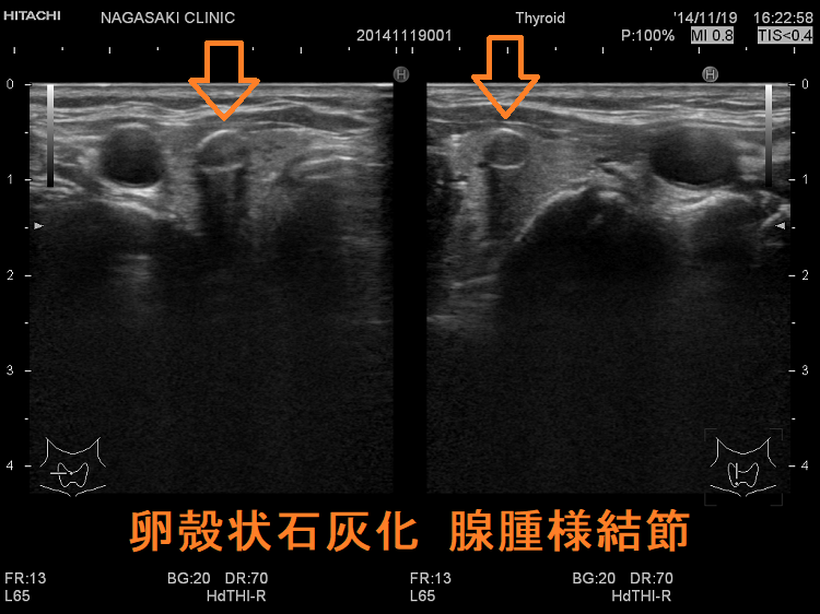卵殻状石灰化 腺腫様結節 超音波(エコー)画像 卵殻状石灰化 腺腫様結節 超音波(エコー)画像