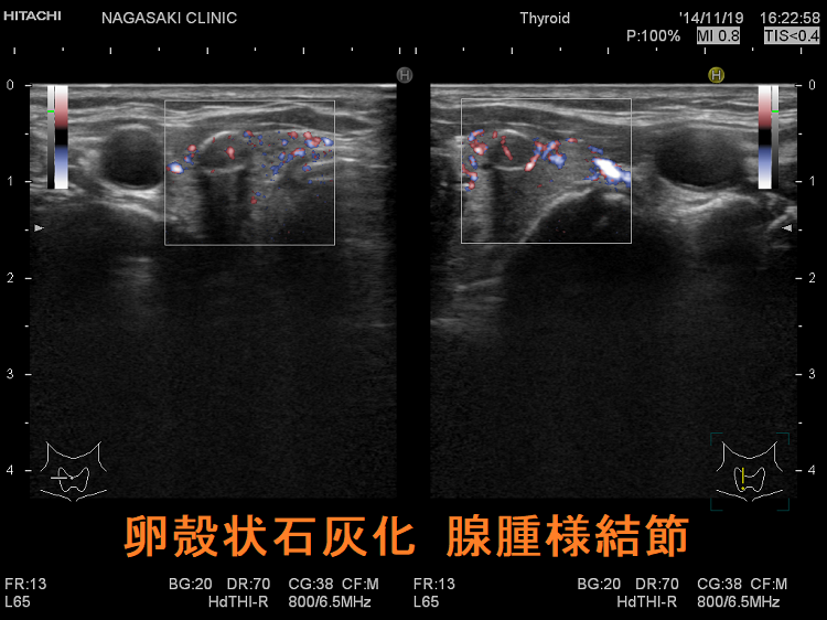 卵殻状石灰化 腺腫様結節 超音波(エコー)画像 ドプラーモード 卵殻状石灰化 腺腫様結節 超音波(エコー)画像 ドプラーモード