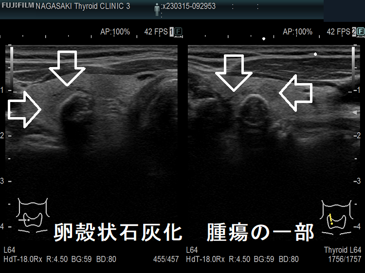 卵殻状石灰化 腫瘍の一部 卵殻状石灰化 腫瘍の一部