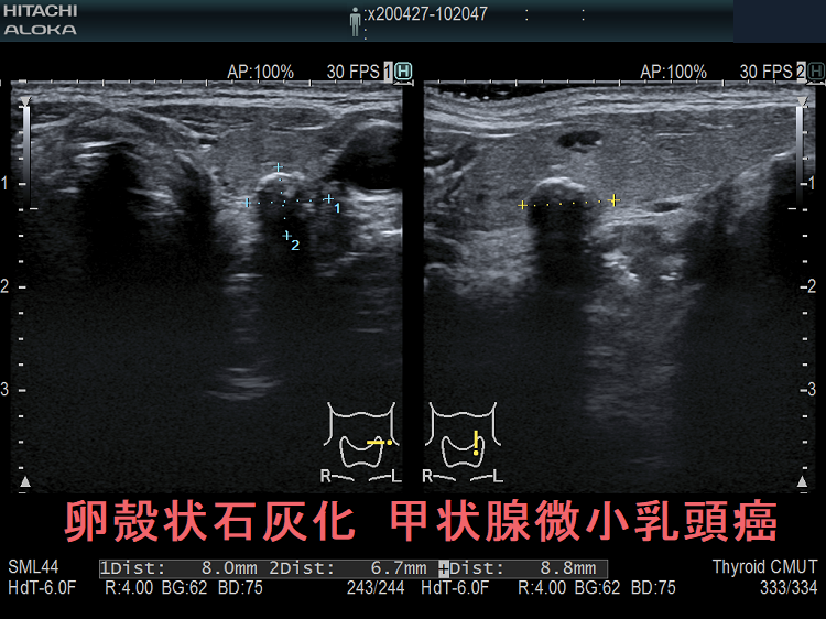 卵殻状石灰化 甲状腺微小乳頭癌 卵殻状石灰化 甲状腺微小乳頭癌