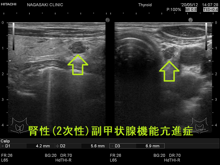 腎性(2次性)副甲状腺機能亢進症 超音波(エコー)画像 腎性(2次性)副甲状腺機能亢進症 超音波(エコー)画像