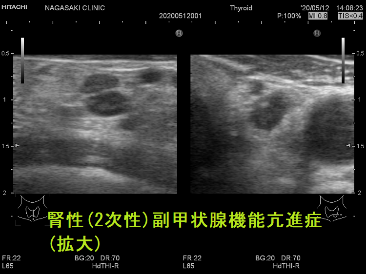 腎性(2次性)副甲状腺機能亢進症(拡大) 超音波(エコー)画像 腎性(2次性)副甲状腺機能亢進症(拡大) 超音波(エコー)画像
